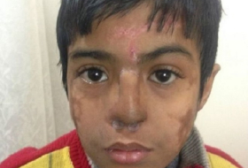 Indian doctors grow new nose on boy`s forehead